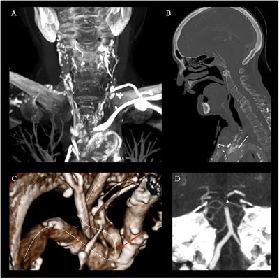 Roadmap Guided Direct Percutaneous Vertebral Artery Puncture for Mechanical Thrombectomy of Acute Basilar Artery Occlusion: A Technical Case Report and Review of the Literature